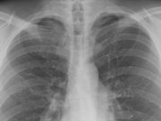 Study Looks Into Long-Term Effects of Vaping on Minors