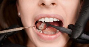 تسوس الاسنان