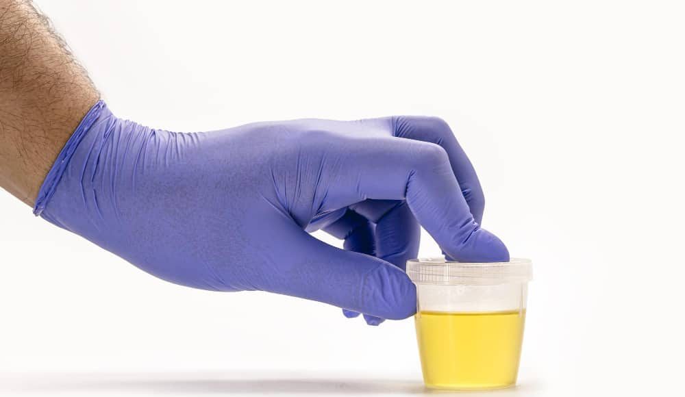 تحليل البول