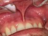 Nicotine Pouches and Oral Health: The Latest Evidence on the Risks and Their Solutions