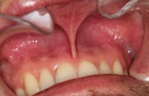Nicotine Pouches and Oral Health: The Latest Evidence on the Risks and Their Solutions