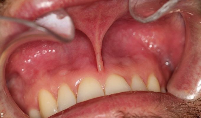 Nicotine Pouches and Oral Health: The Latest Evidence on the Risks and Their Solutions